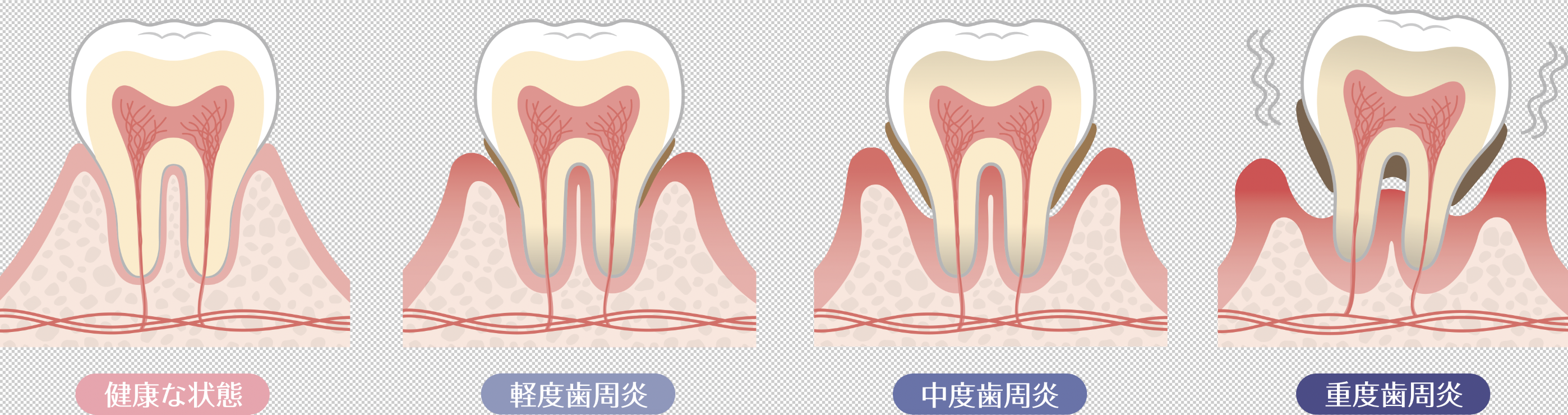 歯周病の進行